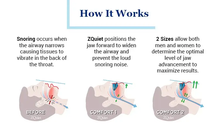 Best 5 Snoring Solutions, Remedies and Devices - The National Times